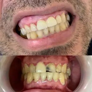 יישור שיניים