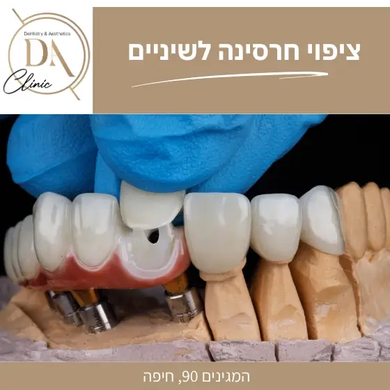 ציפוי חרסינה לשיניים